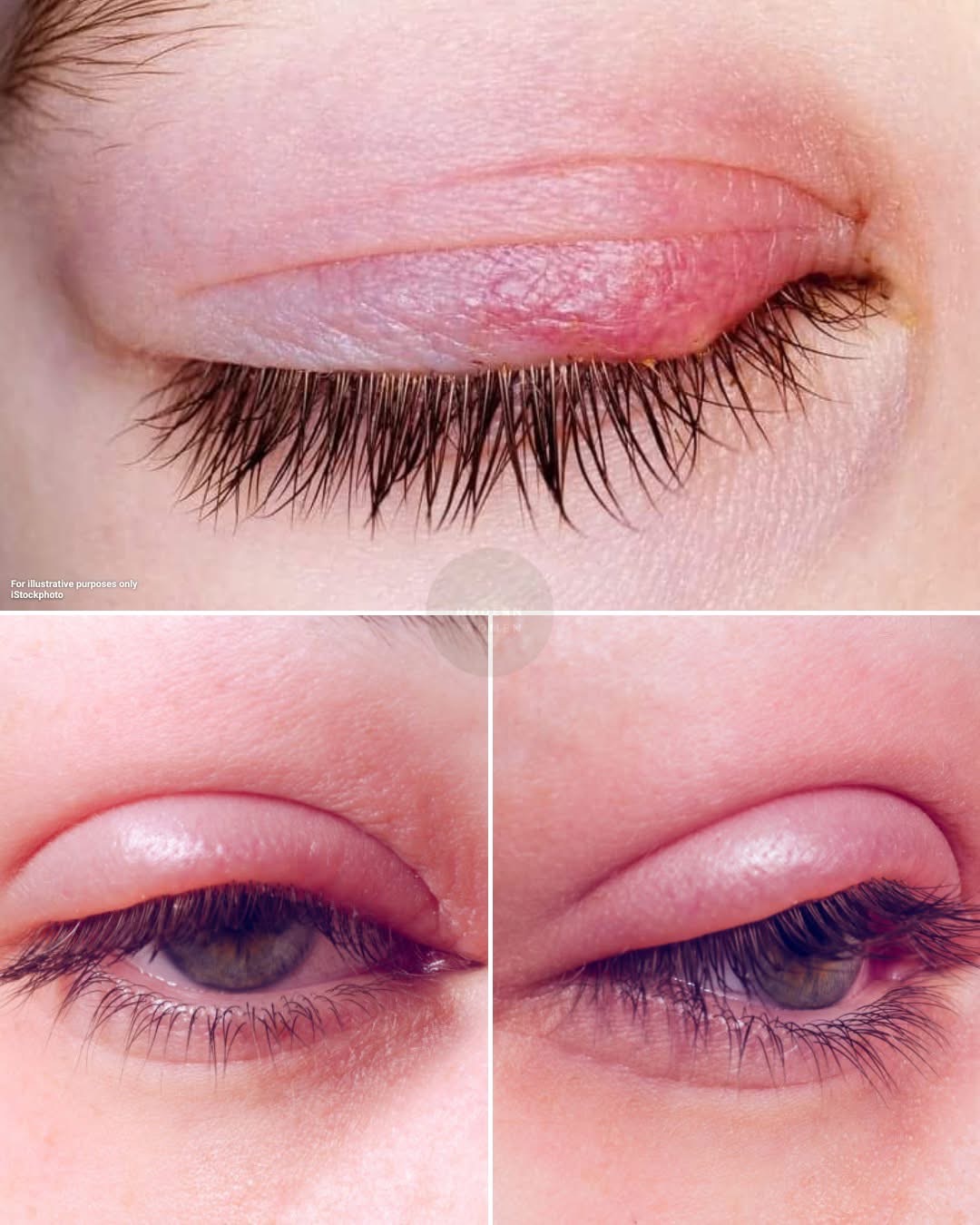 Say Goodbye to Styes