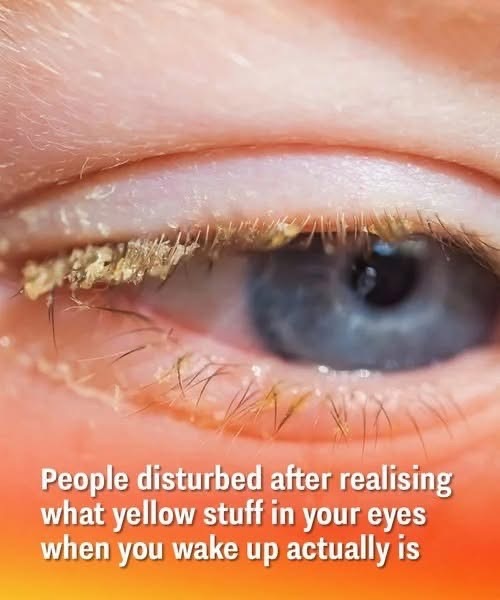 People disturbed after realising what yellow stuff in your eyes when you wake up actually is
