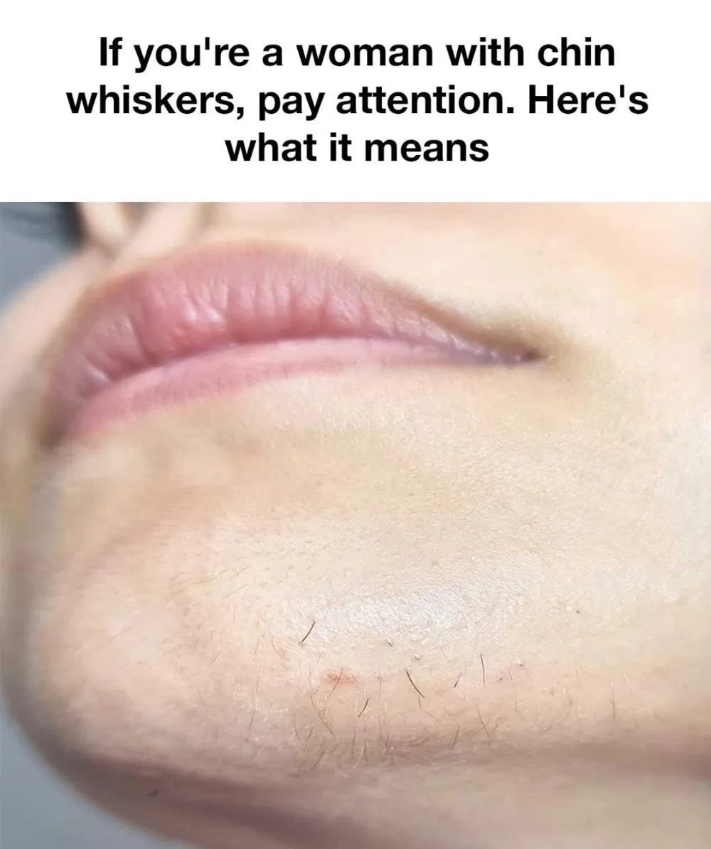 Chin Whiskers in Women