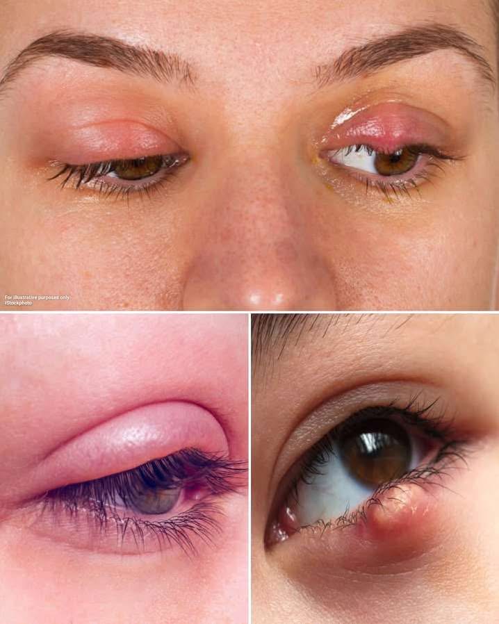 What Causes a Stye? Risks, How You Can Treat …