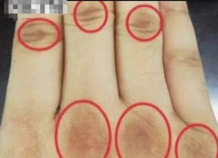 Dark patches appearing on your knuckles suggest your insulin levels are… See more