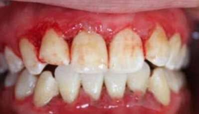 Bleeding gums during tooth brushing could indicate your blood is lacking crucial… See more