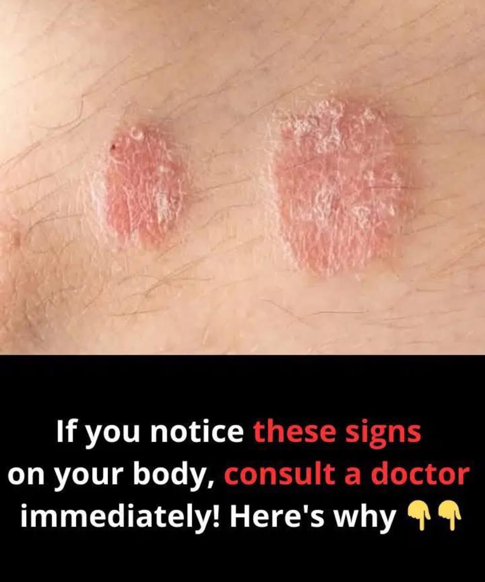 Warning Signs of Psoriasis You Shouldn’t Ignore