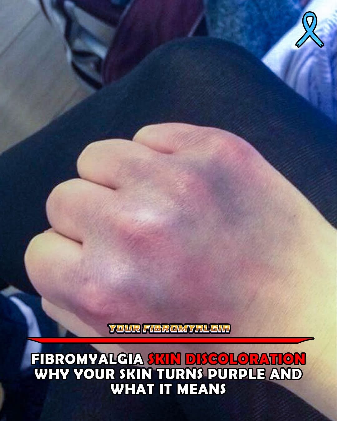 Fibromyalgia Skin Discoloration: Why Your Skin Turns Purple and What It Means