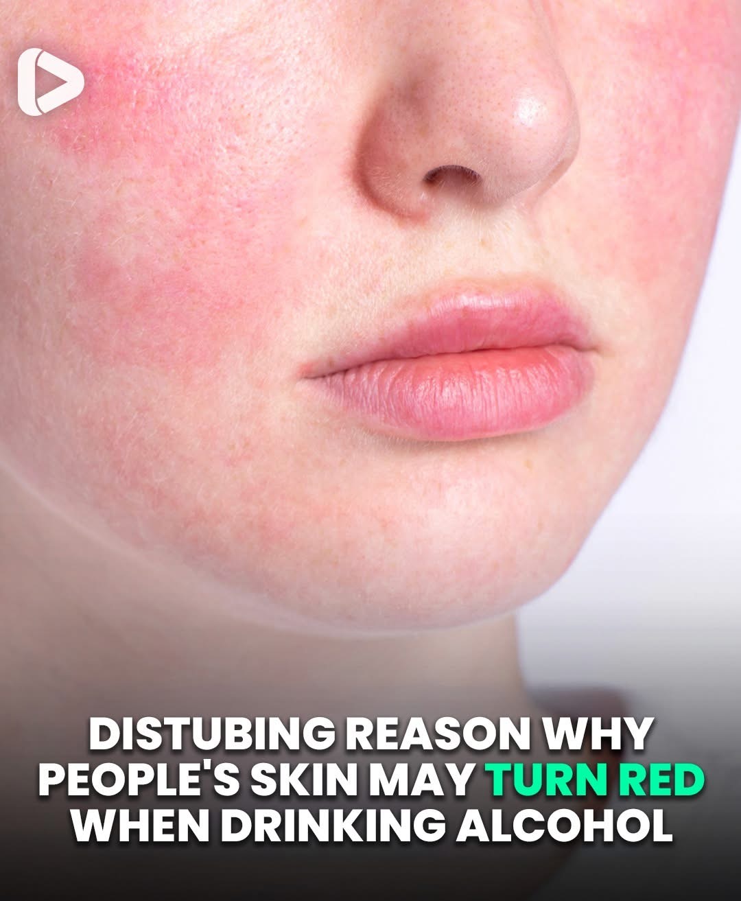 Why Some People’s Skin Turns Red When Drinking Alcohol