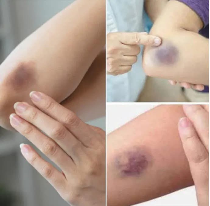 If You Get These Bruises On Your Body