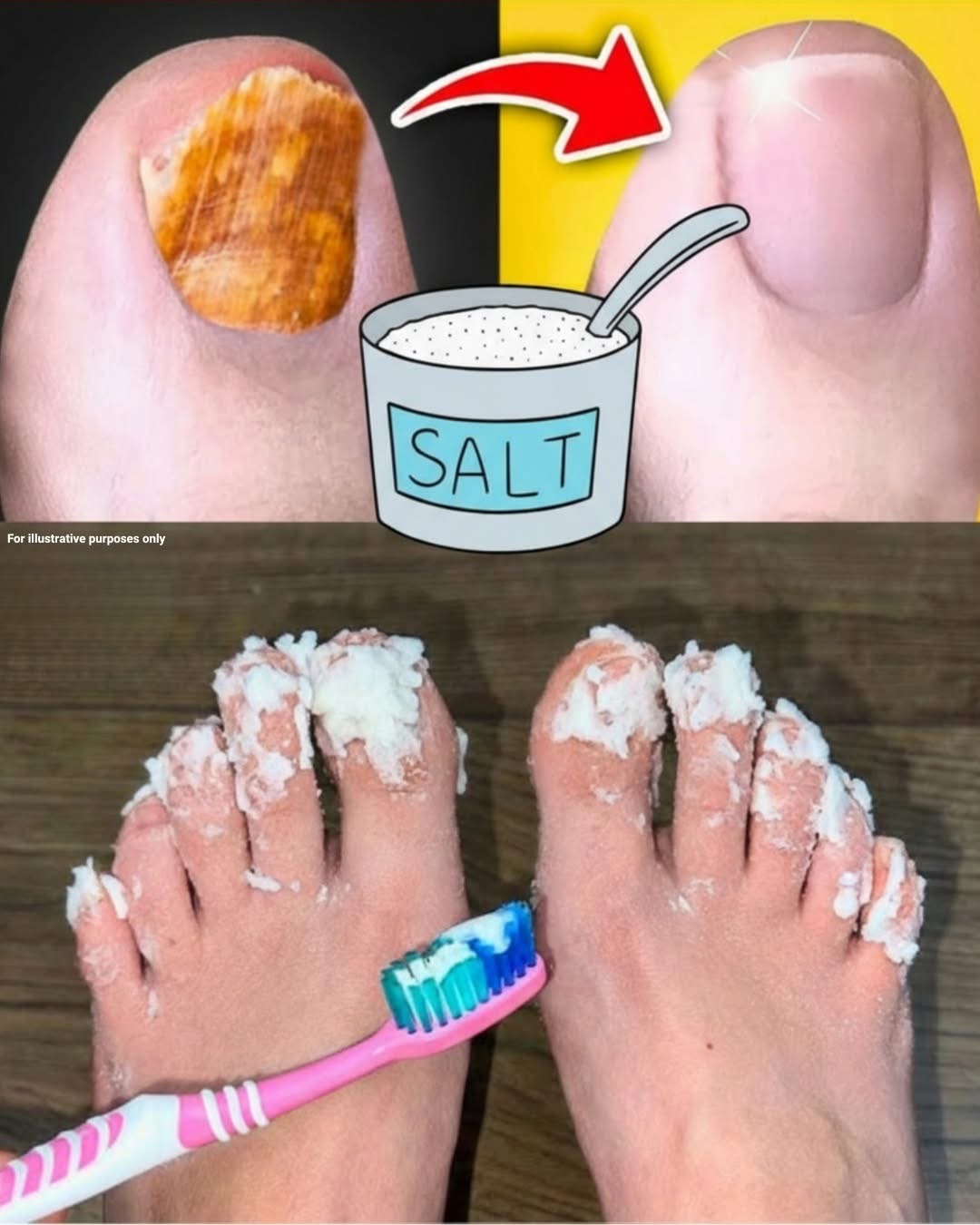 Treating Nail Fungus Naturally