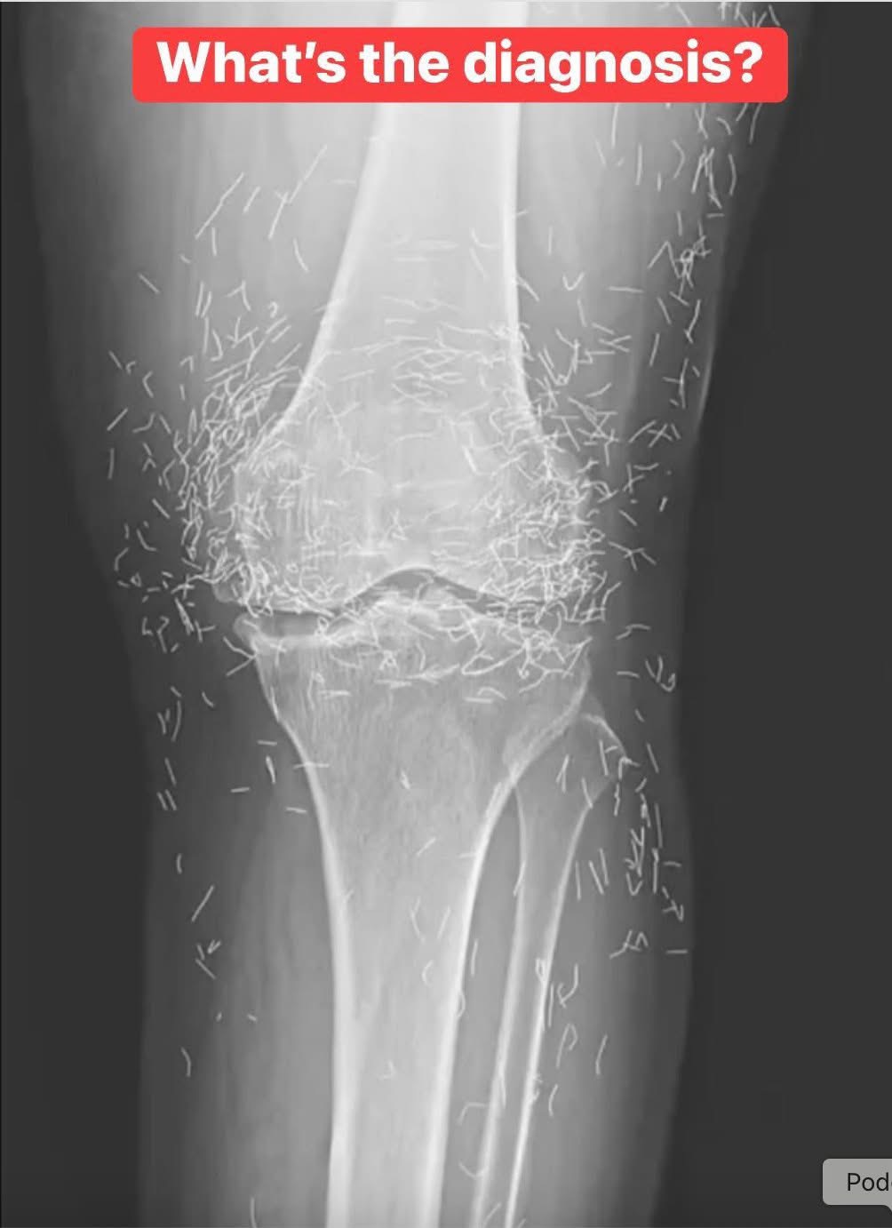 Doctors find “gold mine” in woman’s knees