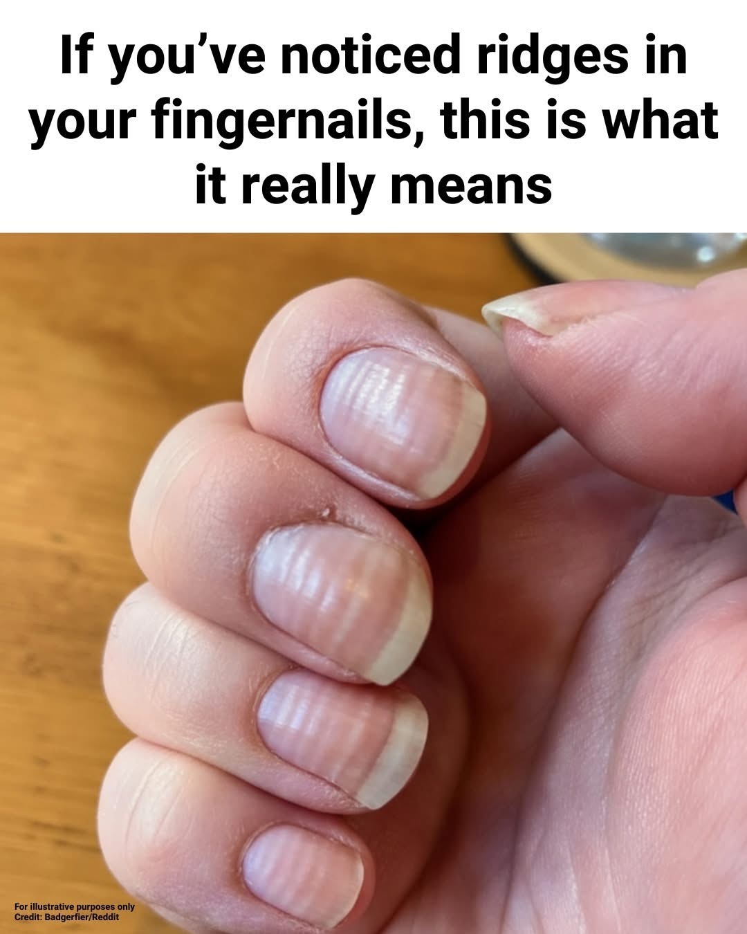 If You’ve Noticed Ridges in Your Fingernails, This Is What It Really Means