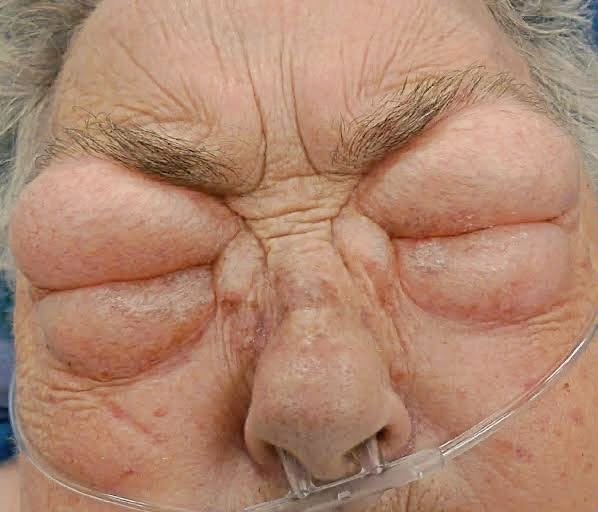 New Heart Failure Case Highlights Game-Changing Drug Class for Patients With Diabetes and Kidney Risk