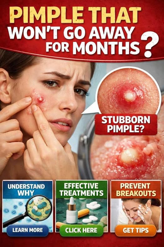 Persistent Pimple Explained