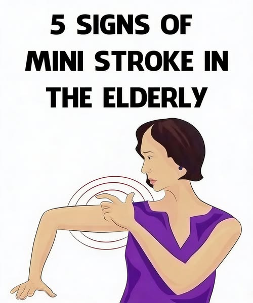 Recognizing Mini-Stroke Warning Signs in Older Adults