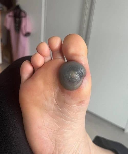 Painful Foot Spot Explained