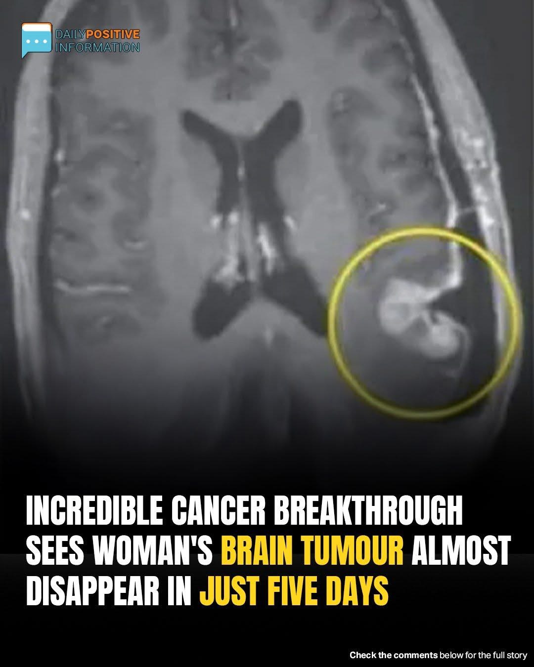 Woman’s Inoperable Brain Tumor Shrinks In Just Five Days Thanks To Cancer Breakthrough