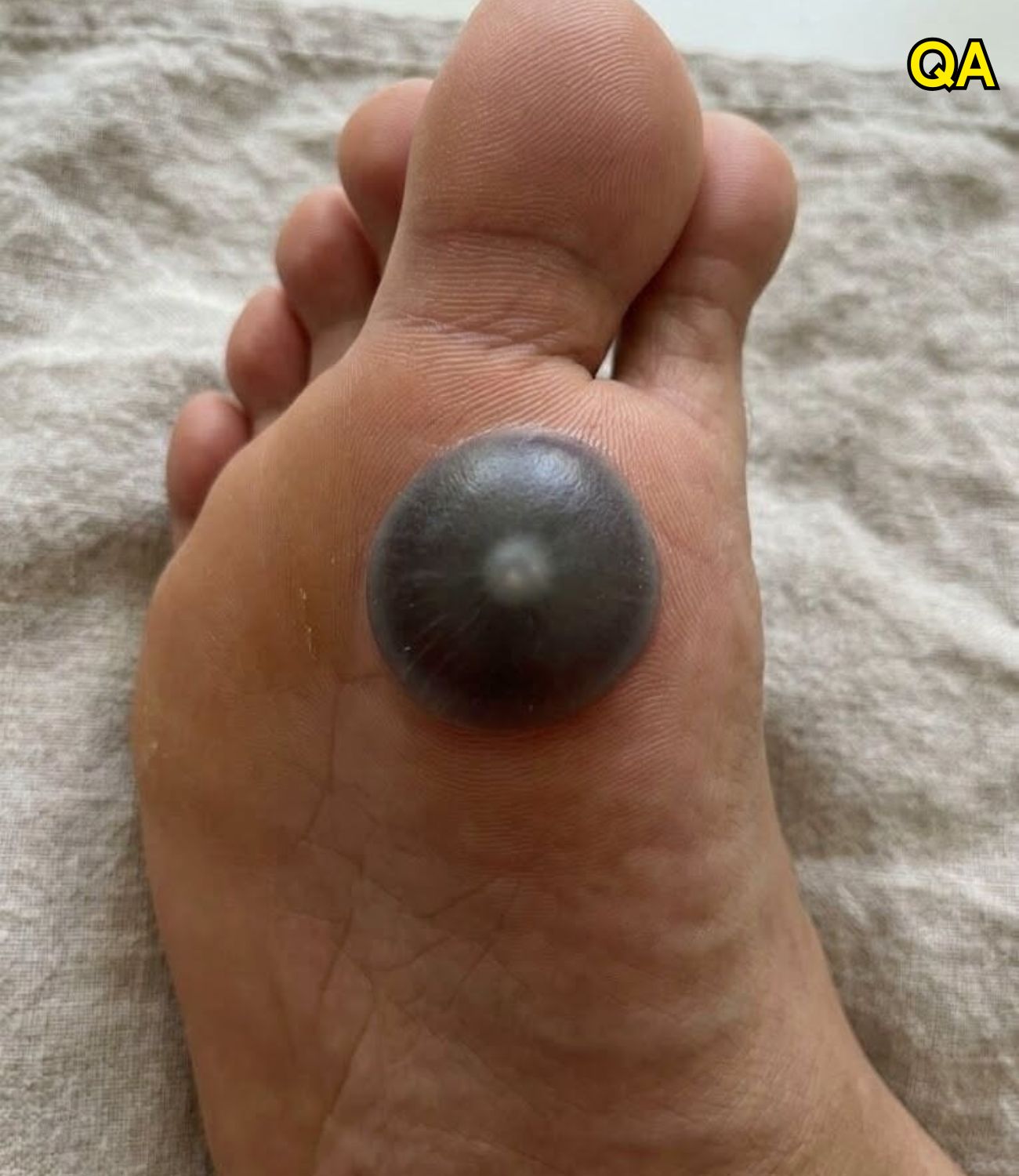 My daughter woke up with this huge spot on her foot I don’t know what it could be. She’s been in pain and can’t move her foot what is this..