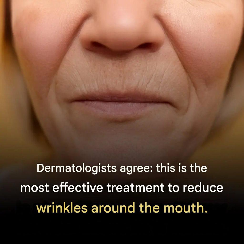 What Really Works for Wrinkles Around the Mouth