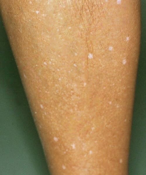 What Vitamin Deficiencies May Lead to White Spots on the Skin