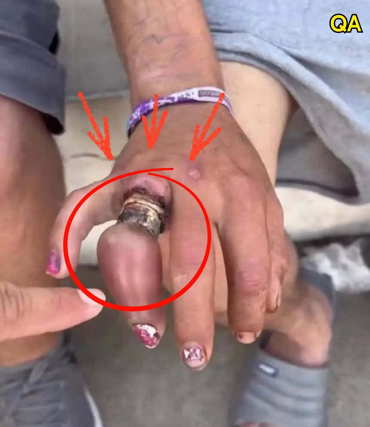 He promised never to take off his wedding ring… and ended up losi…See more