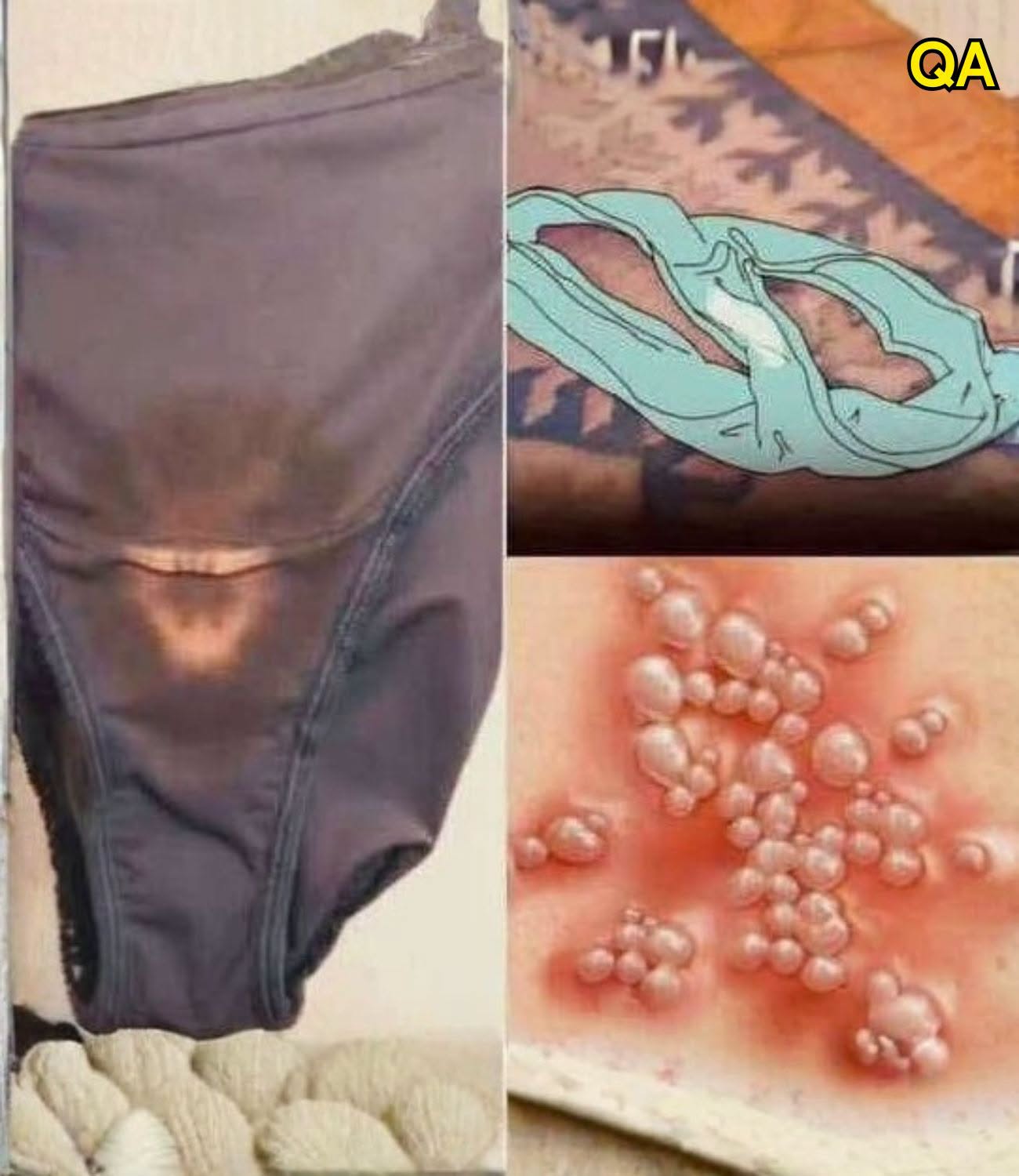 Why You May Notice Bleach-Like Stains on Your Underwear: Causes, Concerns, and When to See a Doctor