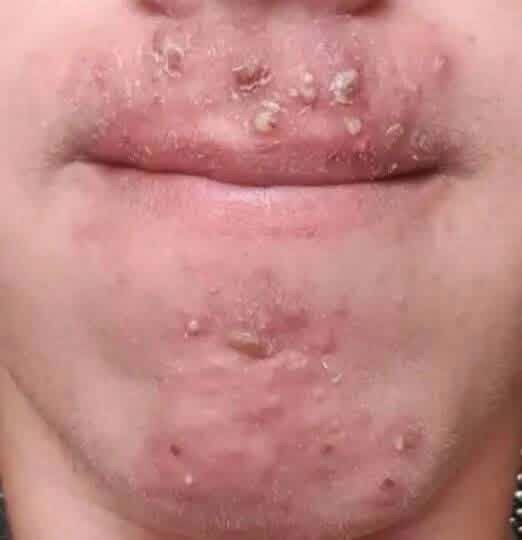 Been dating this woman I met at Walmart and after finally getting some I woke up with these on my face what is this?