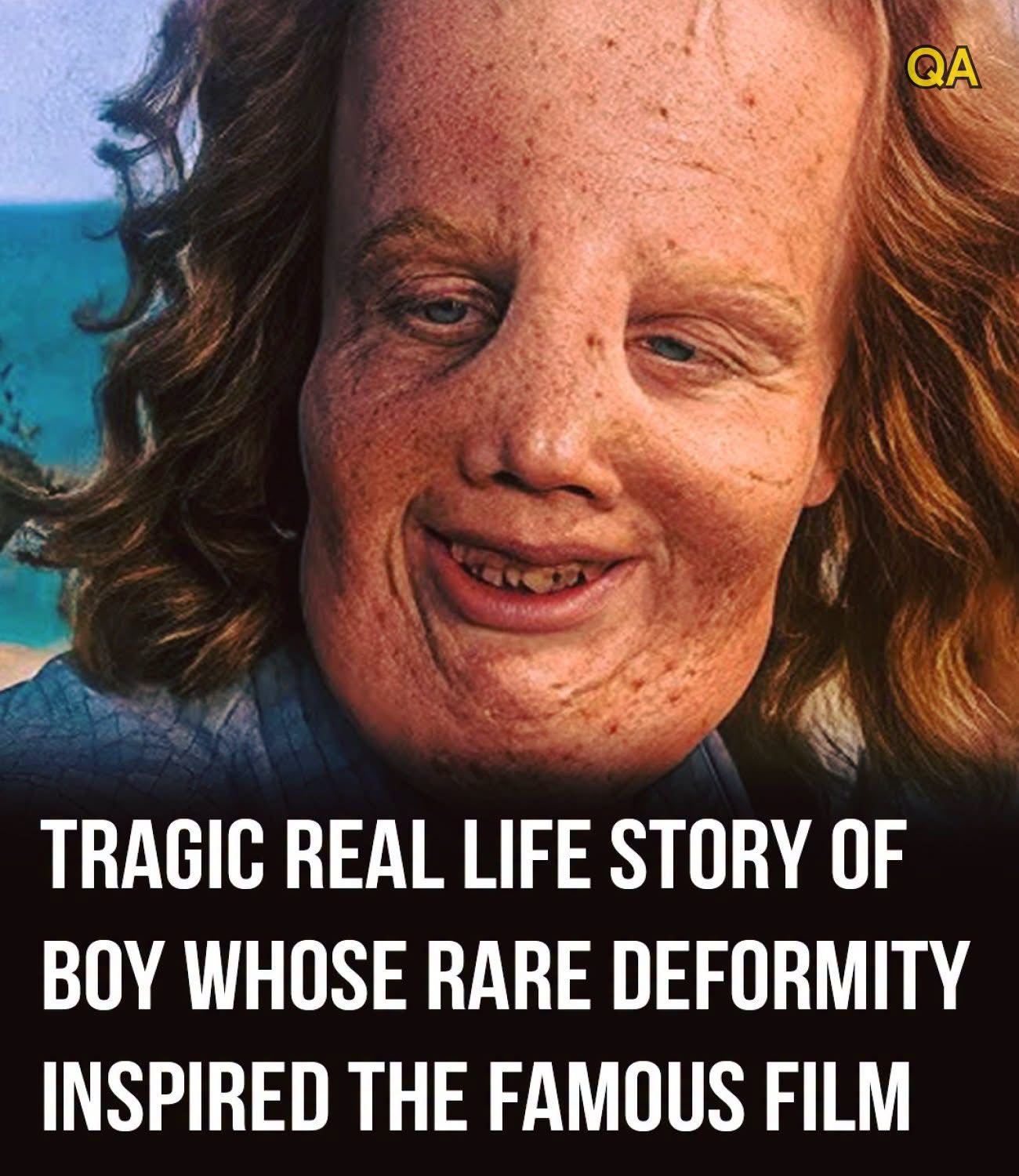 Rocky Dennis: The True Story Of The Boy Who Inspired ‘Mask’