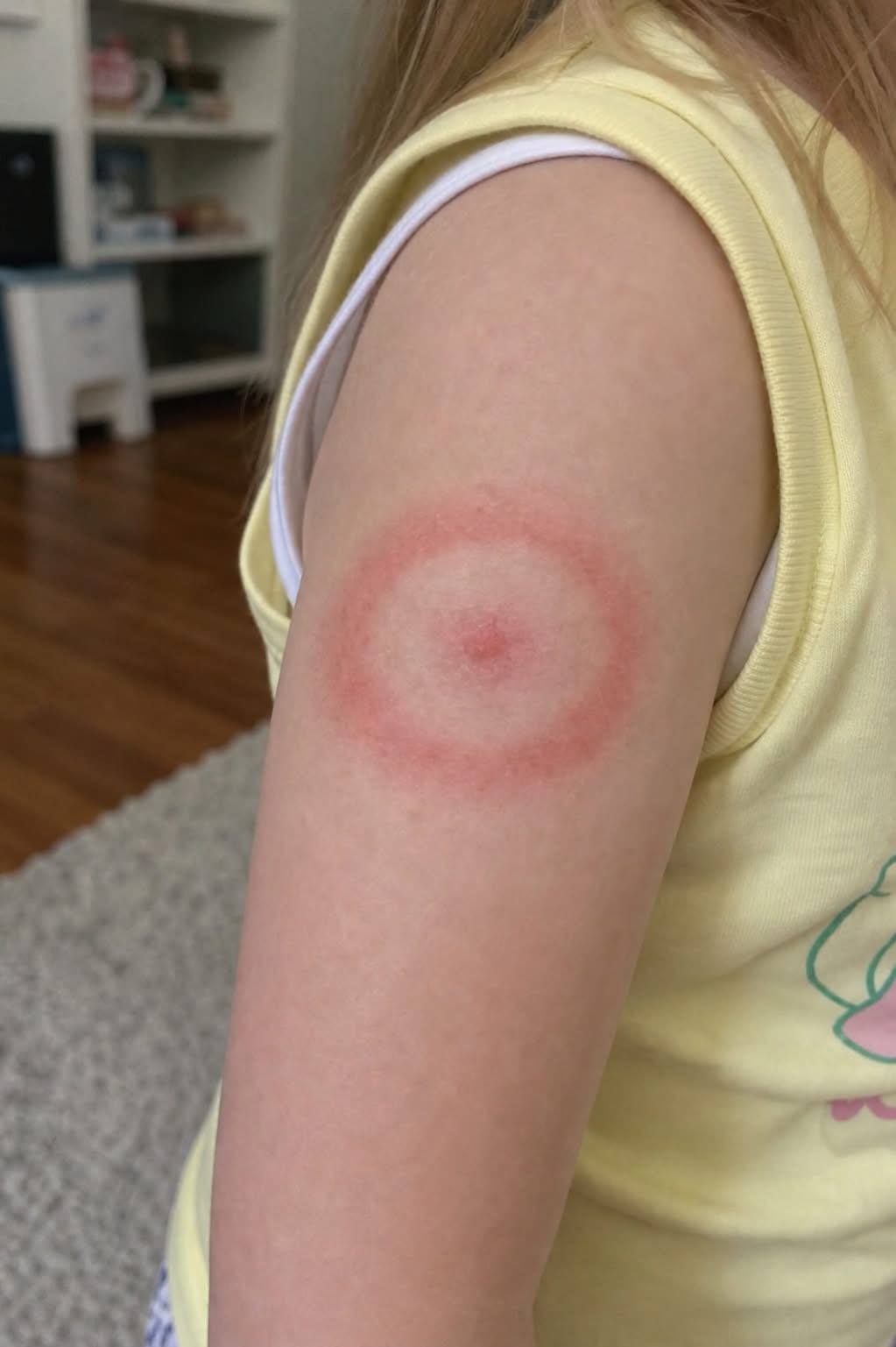 The Red Ring of Terror: Is Your Child’s Mysterious Rash a Harmless Bug Bite or a Life-Changing Diagnosis?