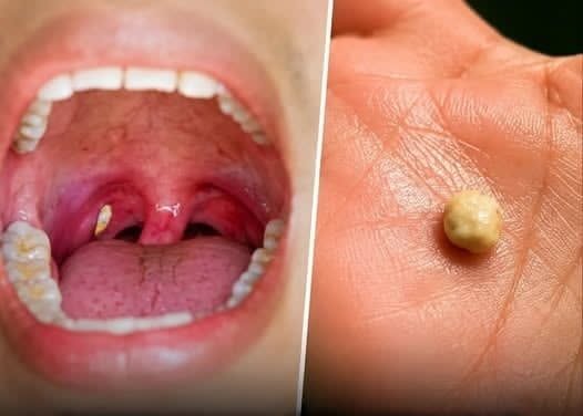 Suddenly Feeling Something Stuck in Your Throat? Hereโs What That Small Lump Could Mean