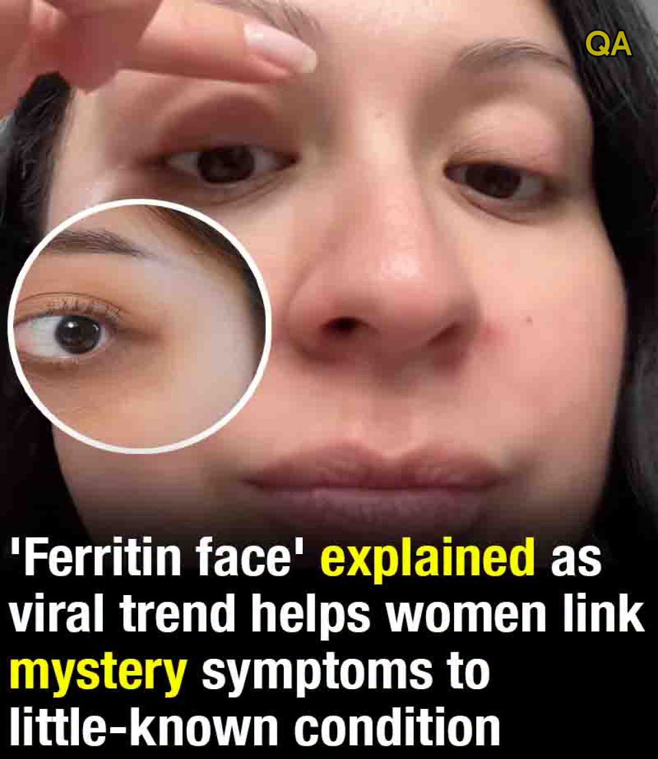 โFerritin faceโ explained as viral trend helps women link mystery symptoms to little-known condition