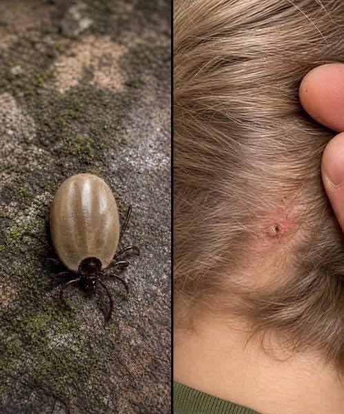 Found a Tick on Your Child? Hereโs What Parents Should Doโand What to Watch For
